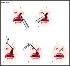 cleft Lip Repair