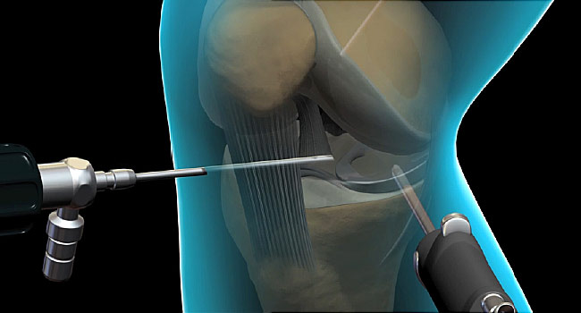 knee arthroscopy illustration