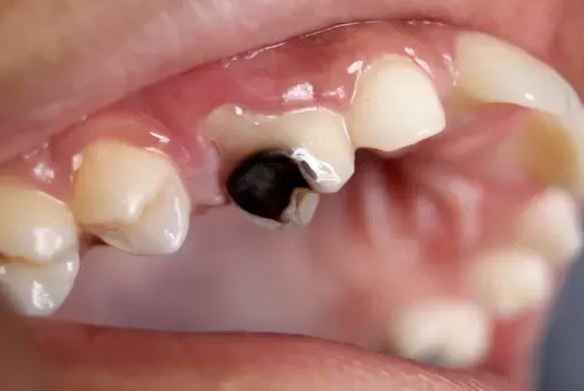 cavity problem_dental problem