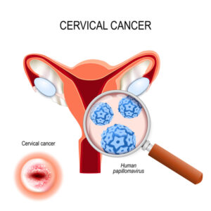 cervical_cancer3