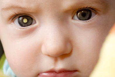 child cataract