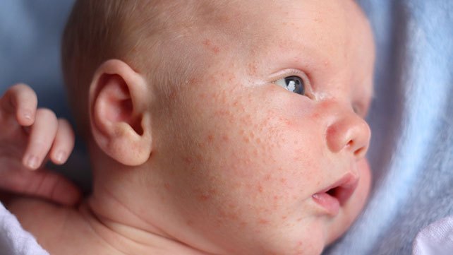acne of baby