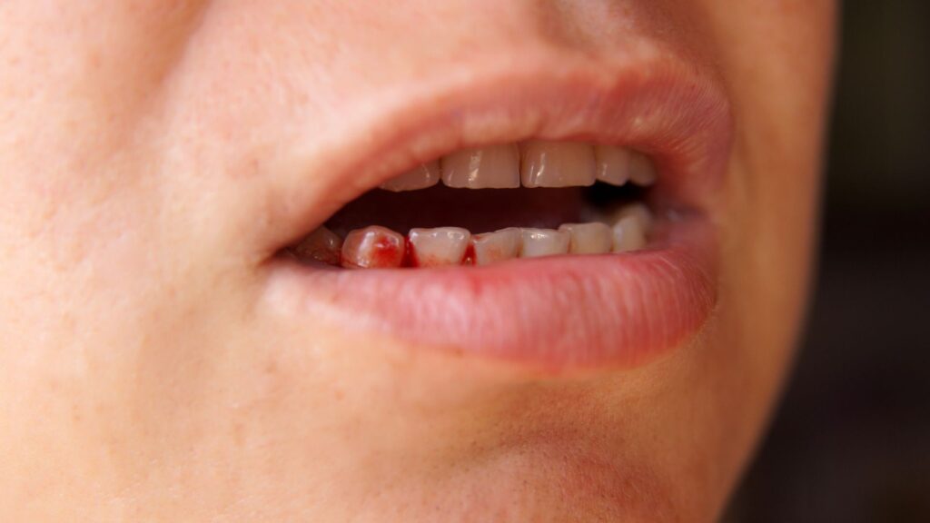 Pyorrhea (Gum Disease)